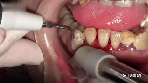 牙石视频,揭秘口腔健康守护之道