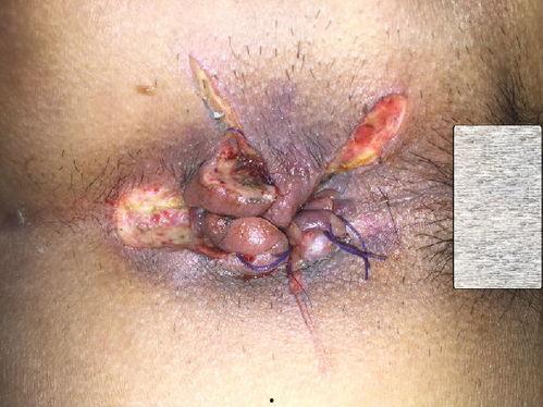 混合痔手术视频,混合痔手术操作步骤及要点解析