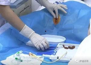 扩张尿道视频,技术革新与患者福祉