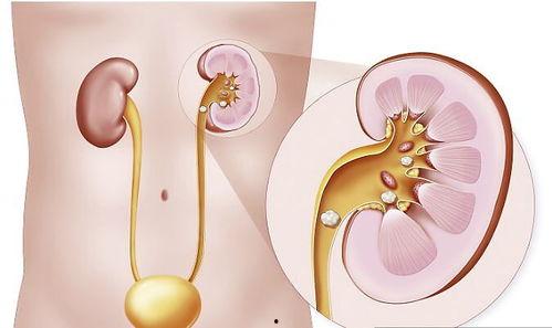 肾结石双j管取出术视频,肾结石双J管取出术操作步骤及要点解析